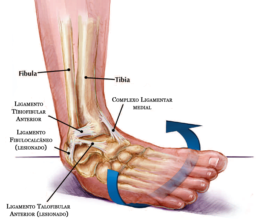 Entorse de cheville, comment réagir ? PAULINE FREUND Ostéopathe D.O.